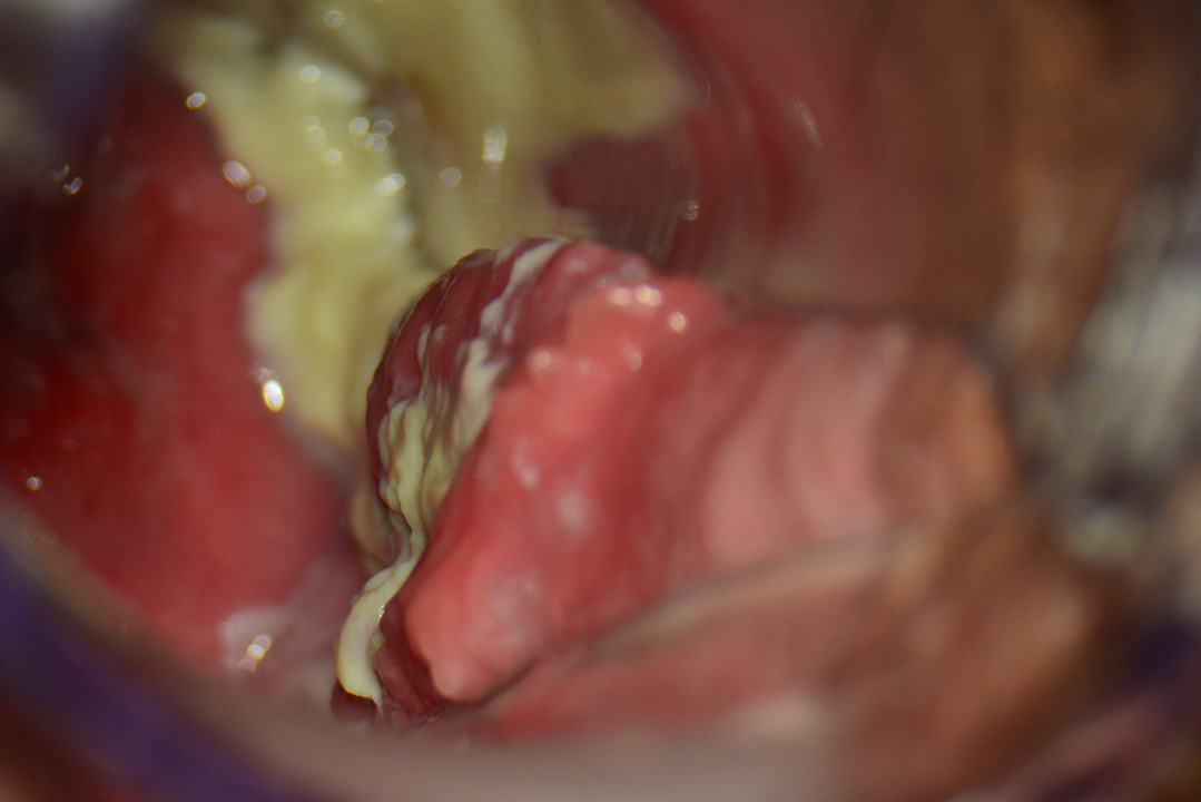 I.U.D. inserita erroneamente, al di fuori della cavità uterina, vista tramite ecografia trans-vaginale