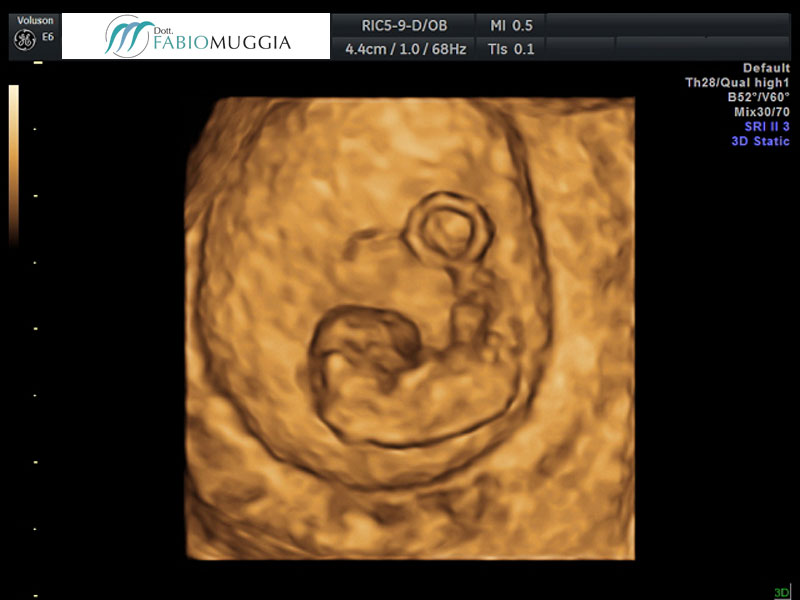 Ecografia T.V. 3D utero bicorne