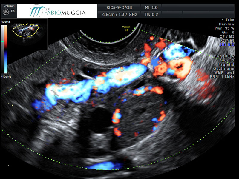 Ecografia T.V. 3D utero bicorne. Si noti che la separazione dell&apos;utero in due distinte cavità inizia ad essere evidente già al livello dell&apos;istmo.