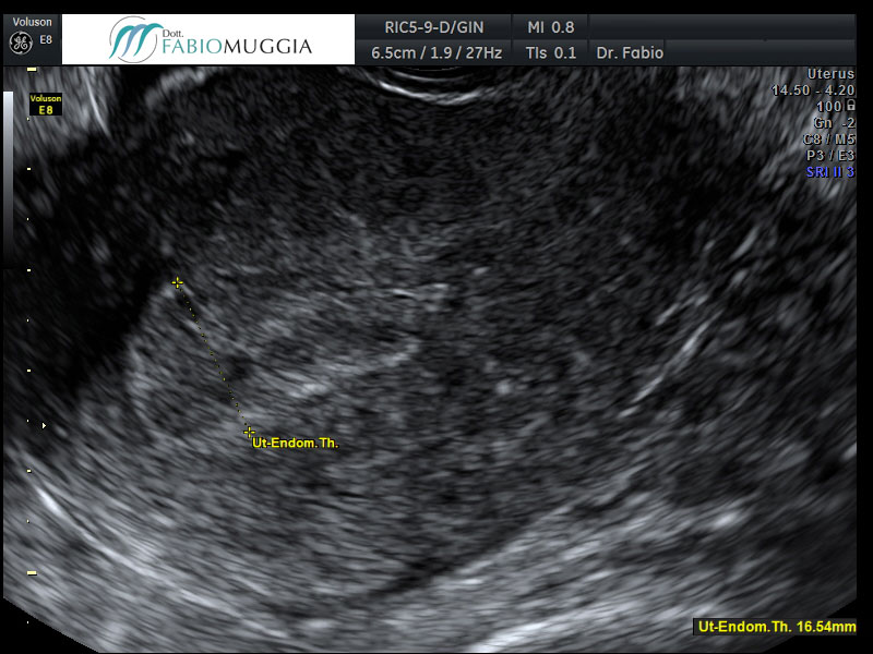 Iperplasia endometriale: osservazione condotta tramite ecografia trans-vaginale