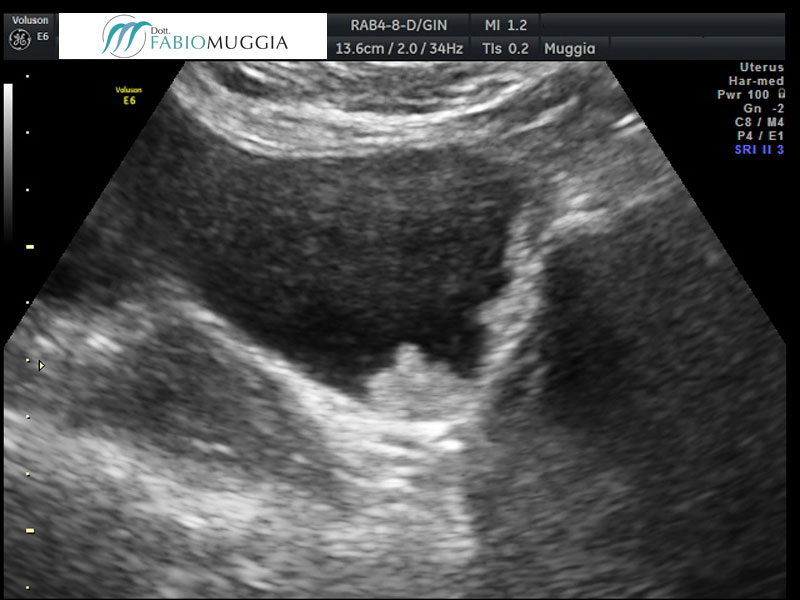 Papillomatiosi neoplastica (tumorale) vescicale: osservazione condotta tramite ecografia trans-vaginale