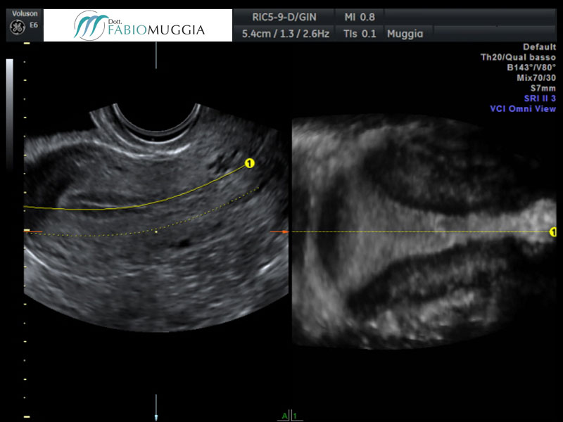 Ecografia trans-vaginale 3D: endometrio proliferativo, a sinistra; cavità uterina normoconformata, a destra