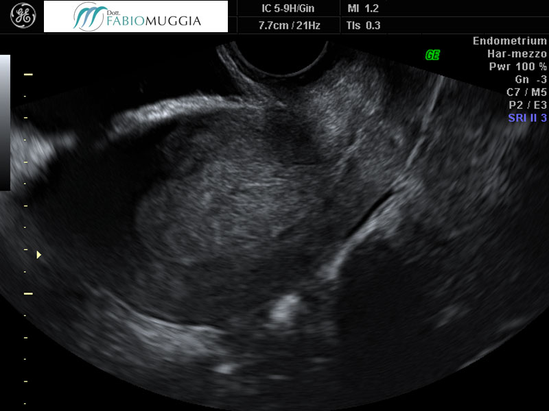 Iperplasia endometriale: osservazione condotta tramite ecografia trans-vaginale