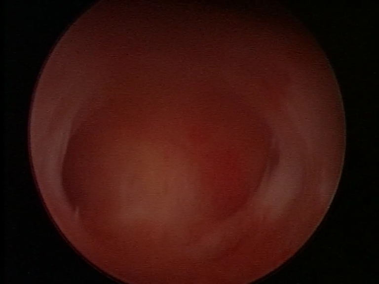 Isteroscopia: utero bicone.