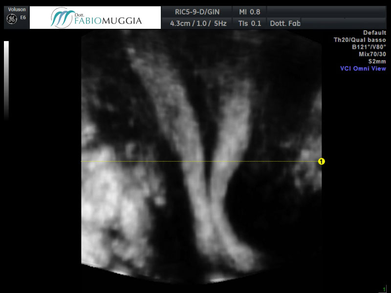 Ecografia T.V. 3D utero bicorne. Si noti che la separazione dell&apos;utero in due distinte cavità inizia ad essere evidente già al livello dell&apos;istmo.