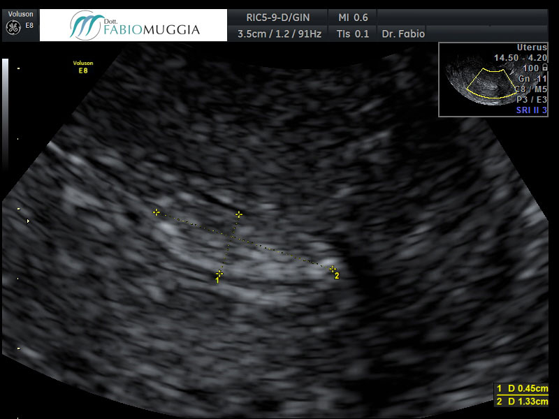 Papillomatiosi neoplastica (tumorale) vescicale: osservazione condotta tramite ecografia trans-vaginale