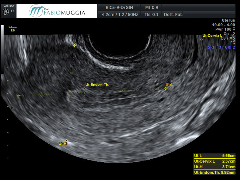 Utero che mostra al suo interno un endometrio tipico della prima fase del ciclo mestruale, la fase proliferativa. Osservazione effettuata per via trans-vaginale.