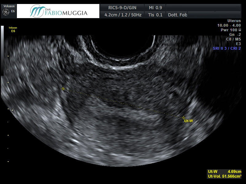 Utero che mostra al suo interno un endometrio tipico della seconda fase del ciclo mestruale, la fase escretiva. Osservazione effettuata per via trans-vaginale.