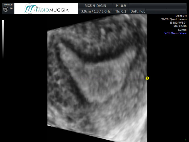 Osservazione effettuata per via trans-vaginale tridimensionale 3D che dimostra un profilo a sella del fondo dell&apos;utero.