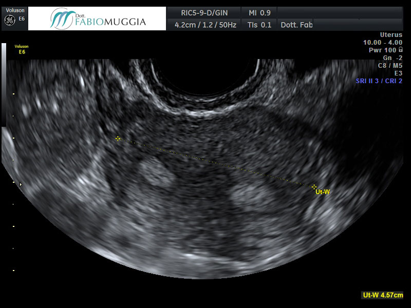 Utero che mostra al suo interno un endometrio tipico della seconda fase del ciclo mestruale, la fase escretiva. Osservazione effettuata per via trans-vaginale.Sorge il sospetto di una malconformazione uterina. Sarà dirimente l&apos;indagine ecografia trans-vaginale tridimensionale 3D.