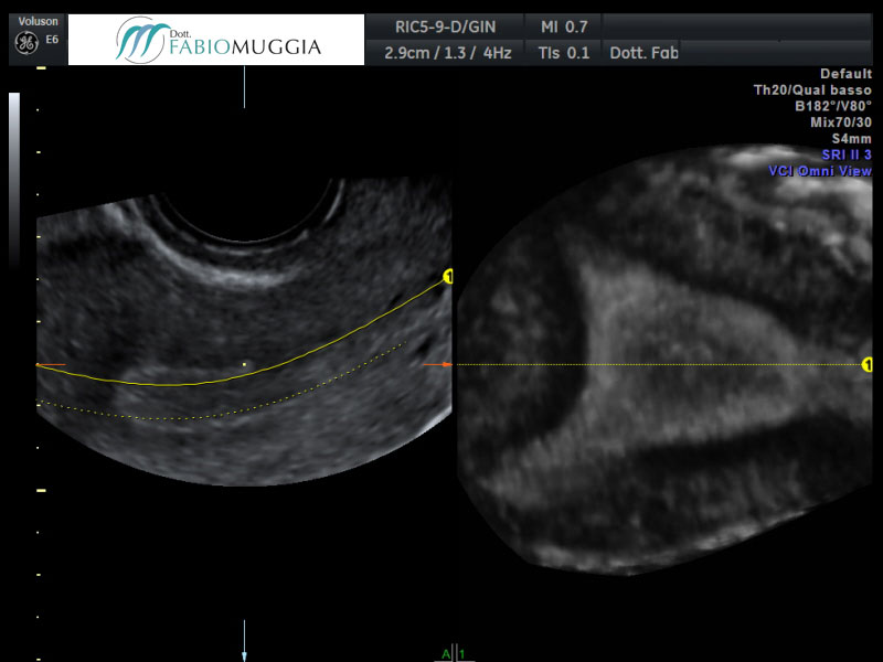 Utero che mostra al suo interno un endometrio tipico della prima fase del ciclo mestruale, la fase proliferativa. Osservazione effettuata per via trans-vaginale tridimensionale 3D.