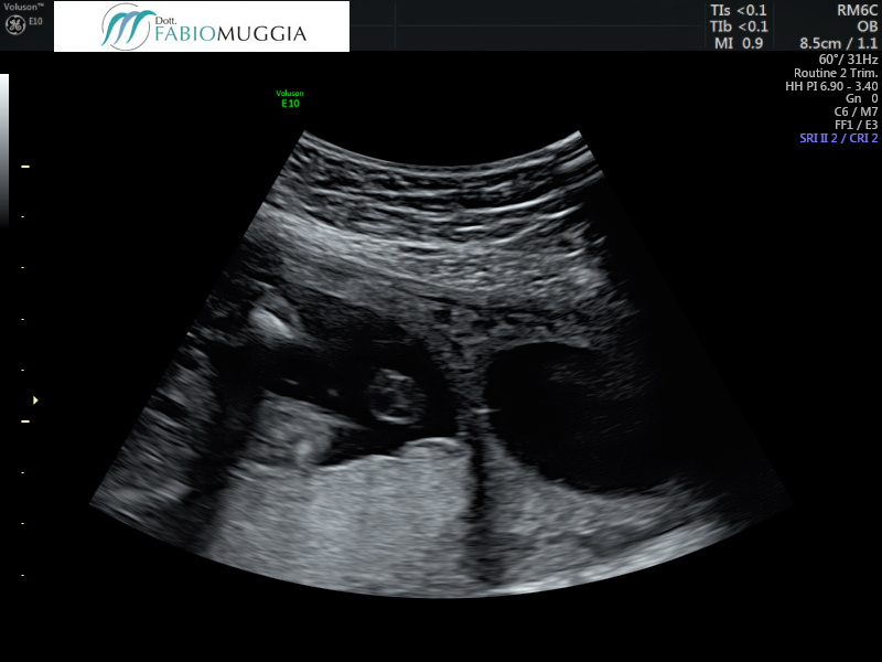 MA: Gravidanza singola nel corno uterino di destra 20 settimane + 4 giorni