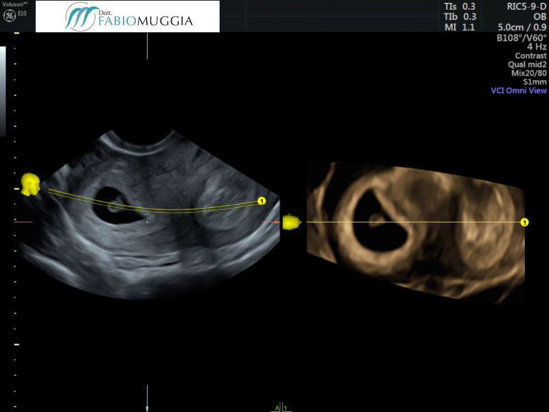 MA: Gravidanza singola nel corno uterino di destra 6 settimane + 3 giorni