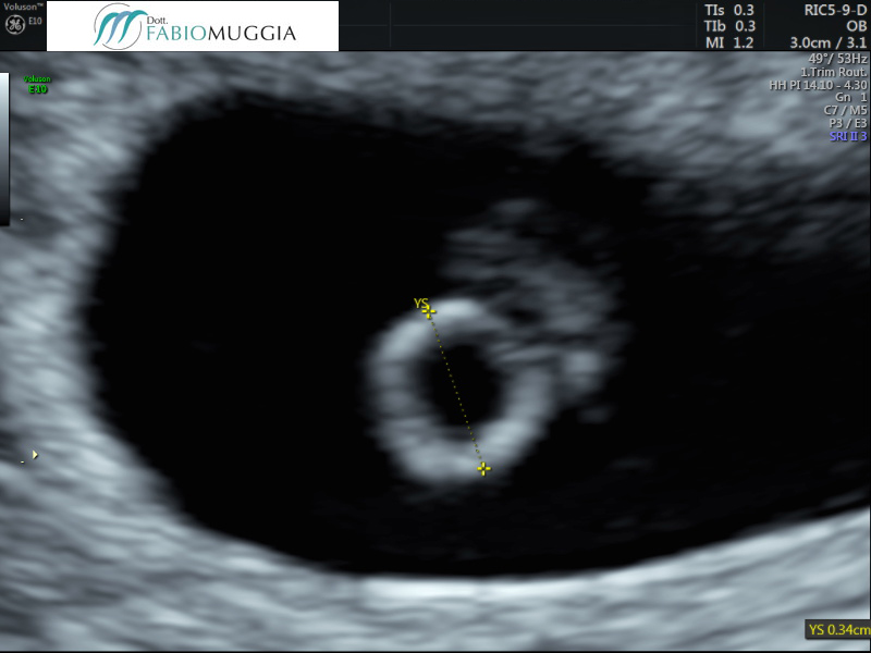 MA: Gravidanza singola nel corno uterino di destra 6 settimane + 3 giorni