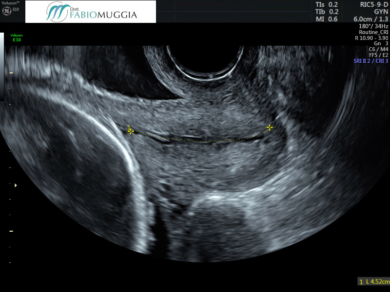 Collo uterino normale, di lunghezza conservata, con il capo fetale adagiato. Si intuisce che l’orifizio uterino interno è «conservato e chiuso».
