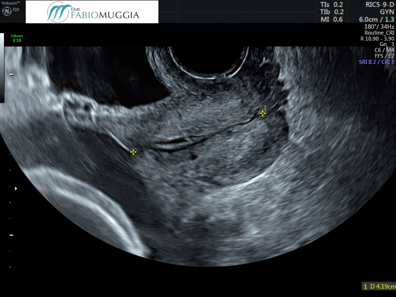 Collo uterino normale, di lunghezza conservata, con il capo fetale che è stato «sospinto», per far «vedere» (e non solo intuire o supporre) che l’orifizio uterino interno è «conservato e chiuso».