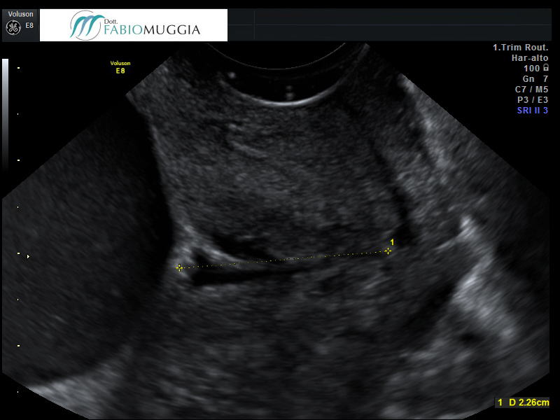 Tramite l’ecografia transvaginale si nota un iniziale minimo (giudizio secondo esperienza) «ampliamento» del tratto più interno del canale cervicale.