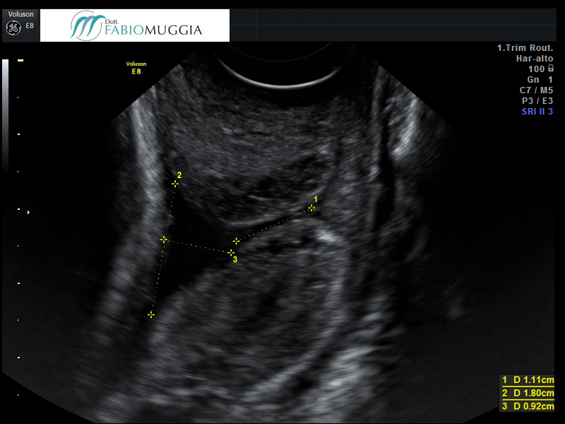 Tramite l’ecografia transvaginale si nota un iniziale, ma chiaramente visibile netto «ampliamento» del tratto più interno del canale cervicale.