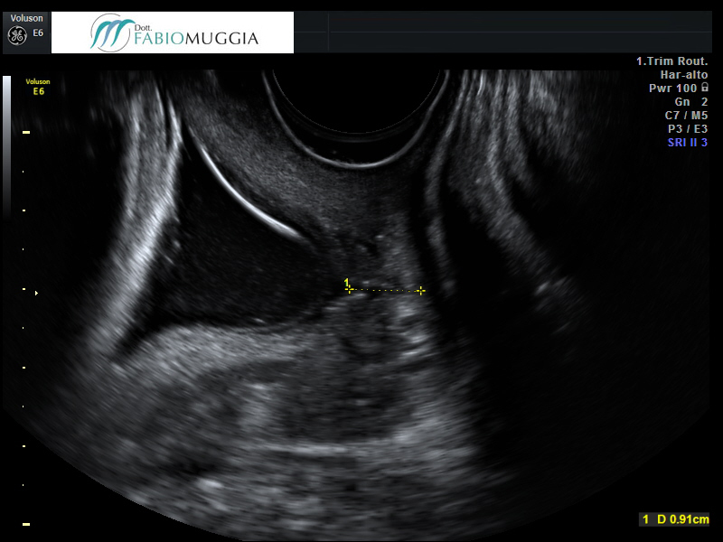 Si nota il vistoso «imbuto» che indica il «cedimento» della struttura dell’ orifizio uterino interno, il vero elemento di tenuta che permette al feto di rimanere in utero fino al termine della gestazione, fino all’inizio del travaglio di parto.